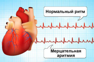 Чем опасна аритмия сердца