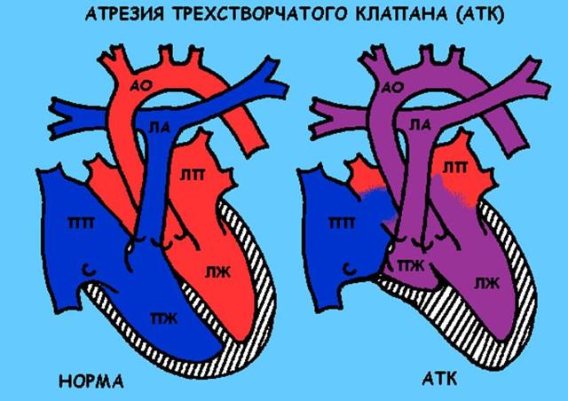 Операция при пороке сердца у ребенка как проходит -