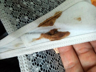 Коричневые выделения через неделю после месячных