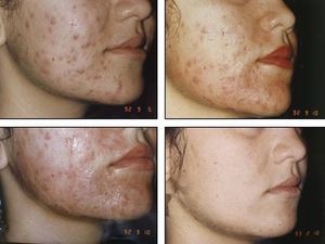 Переливание крови из вены в ягодицу: особенности процедуры