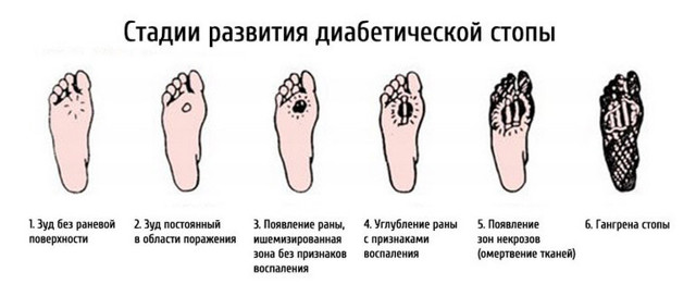Отекают ноги при сахарном диабете - что делать?