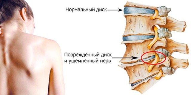 Покалывание в верхней части грудной клетки
