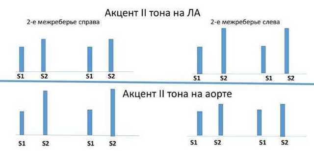 Аускультация сердца (выслушивание): точки, алгоритм, суть