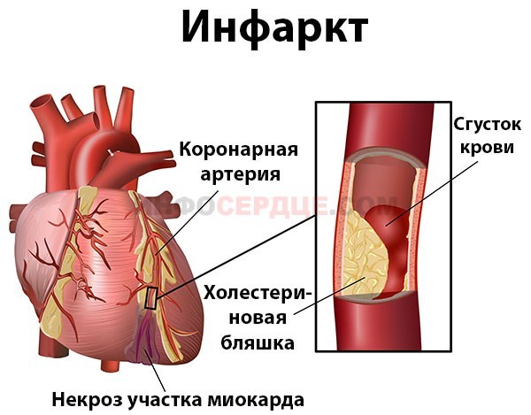 Что делать, если беспокоит жжение в области сердца