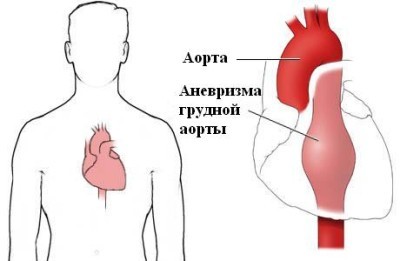 Аневризма грудного отдела аорты: диагностика и лечение