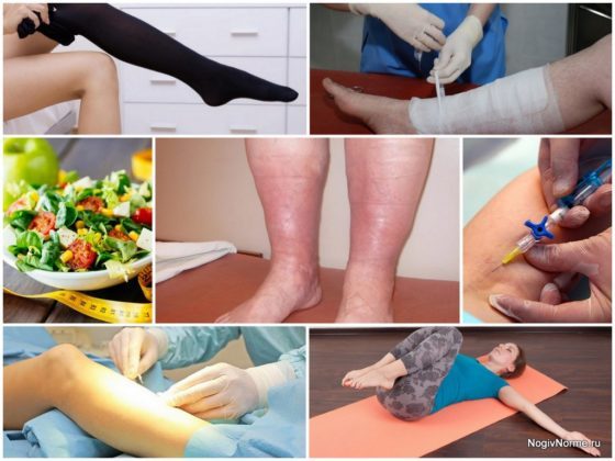 Отеки при варикозе - снимаем быстро и надолго