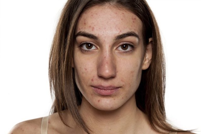 Красные пятна на теле у взрослого - появились красные пятнышки на лице