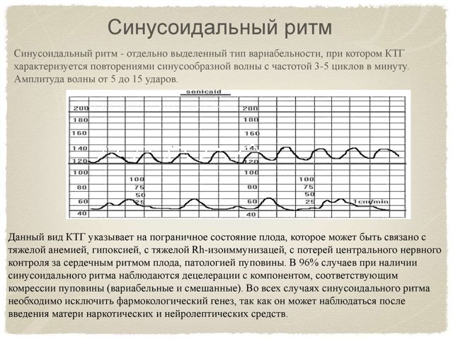 КТГ при беременности: расшифровка и норма, сроки и что показывает по неделям - видео