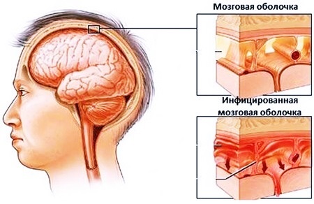 Менингит – симптомы и лечение у детей по видам заболевания