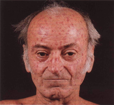 Системная склеродермия - диагностика, лечение, прогноз