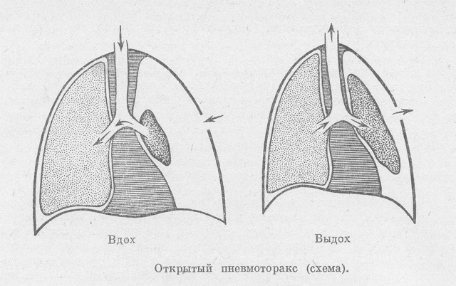 Легочное сердце (хроническое и острое): что это такое, симптомы, диагностика и лечение