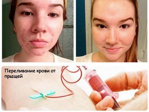Переливание крови из вены в ягодицу: особенности процедуры