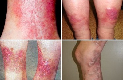 Варикозный дерматит нижних конечностей лечение народными средствами на сайте варикоз