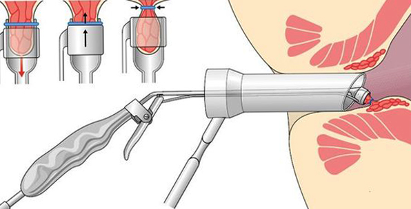 Что такое лигирование внутреннего геморроидального узла — Сайт о геморрое