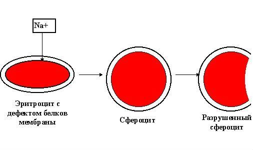 Болезнь Минковского-Шоффара: симптомы, причины возникновения, лечение