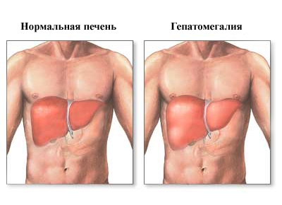 Болезнь крови. Болезни органов крови