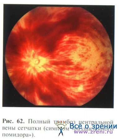 Ишемические заболевания сетчатки глаза и зрительного нерва