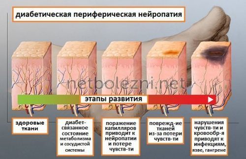 Мазь при полинейропатии нижних конечностей: классификация, медикаменты, народные средства, проявления
