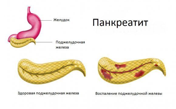 Норма диастазы в моче у взрослых и детей: при панкреатите, анализ, расшифровка результатов