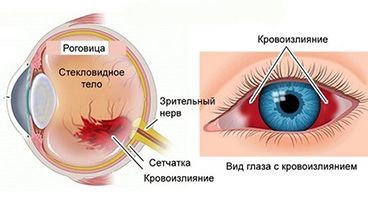 Кровь в глазном яблоке - Лечение глаз