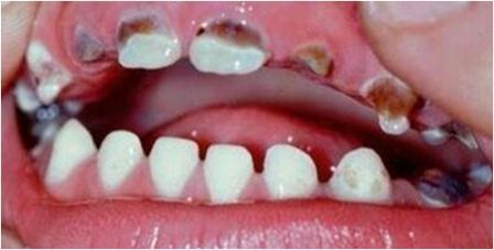 Пришеечный кариес - причины, симптомы, диагностика и лечение