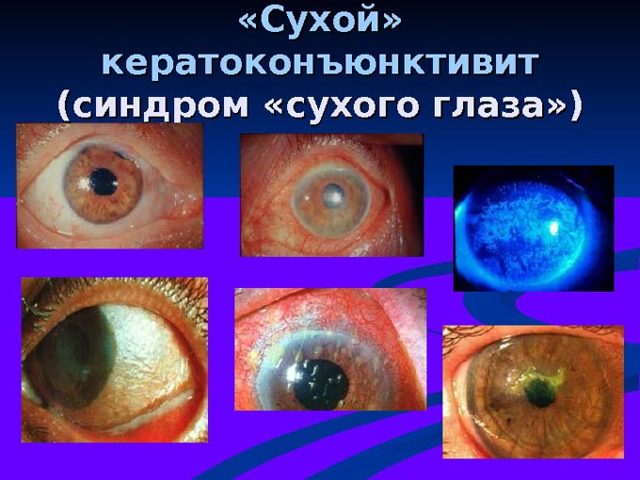 Видисик – инструкция по применению геля глазного, отзывы, цена, аналоги