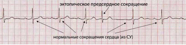 Предсердный ритм норма или патология?