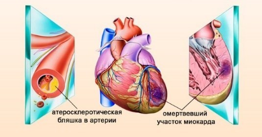 Резкое снижение артериального давления последствия - Лечение гипертонии