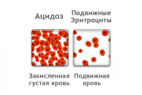 Лактоацидоз при сахарном диабете 2 типа - что это такое, симптомы