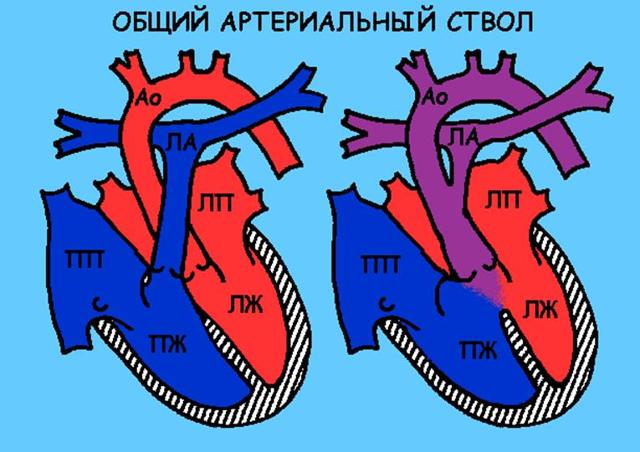 Операция при пороке сердца у ребенка как проходит -