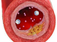 Как снизить гемоглобин в крови