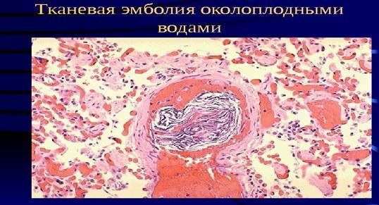 Эмболия: что это такое, ее виды и причины, диагностика, лечение