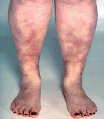 Васкулит на ногах - что это такое и как лечить?