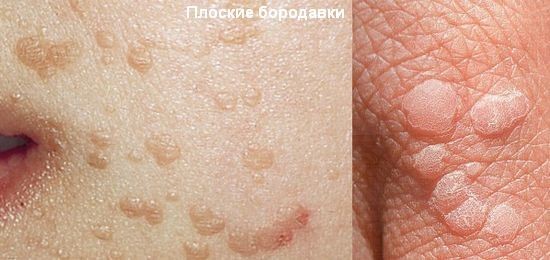 Что такое бородавка и как с ней бороться?