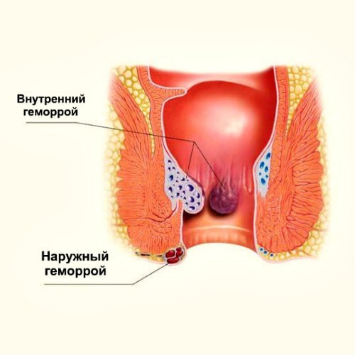 Как применять мазь вишневского при геморрое — Сайт о геморрое