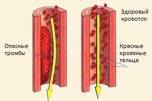 Прижигание при аритмии сердца — Сердце