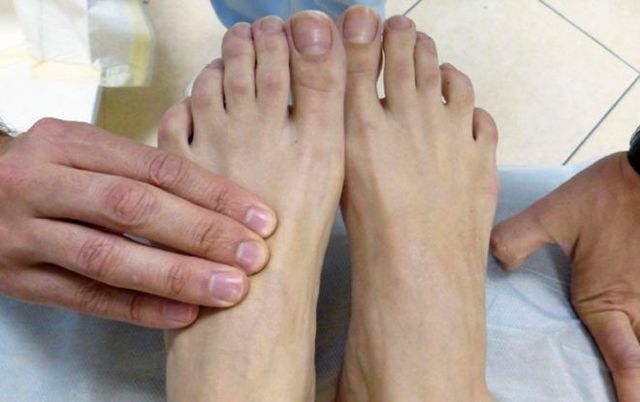 Облитерирующий эндартериит сосудов нижних конечностей - симптомы и лечение