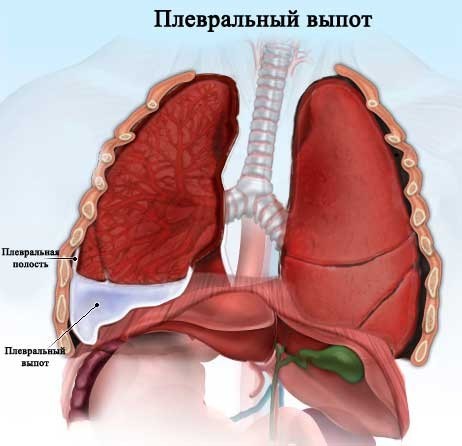 Плеврит легких, симптомы и лечение заболевания