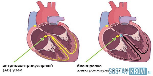 Что такое блокада сердца 1 степени