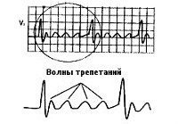 Лечение трепетания предсердий - методы Лечение трепетания предсердий сердца у мужчин, женщин и детей.