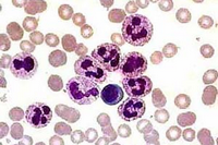 Если палочкоядерные нейтрофилы 0 у взрослого – о чем это говорит. Почему у ребенка повышены сегментоядерные и палочкоядерные нейтрофилы: причины высоких показателей в анализе крови