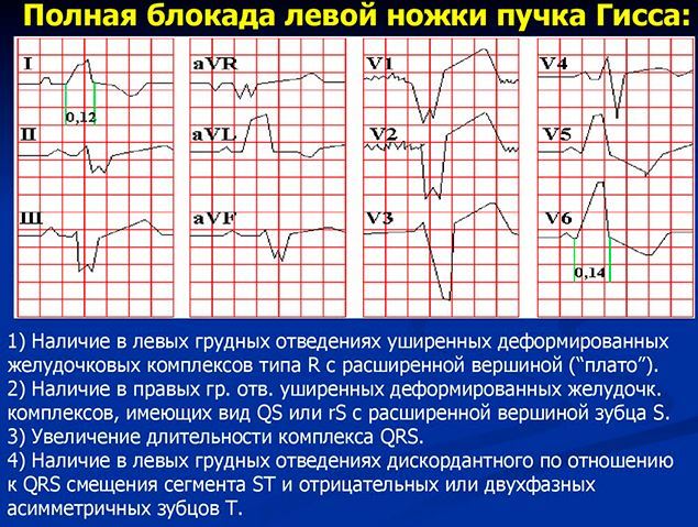 Неполная блокада левой ножки пучка Гиса - причины, лечение