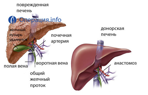 Пересадка печени: виды, выбор донора, ход процедуры.
