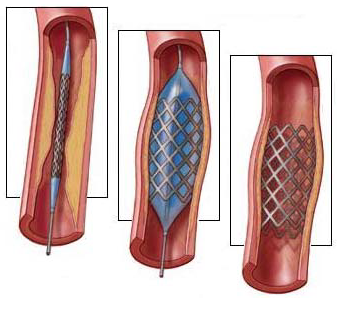 Операция по чистке сосудов нижних конечностей