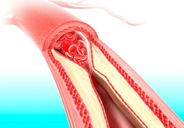 Инсульт спинного мозга (спинальный): симптомы, лечение, последствия