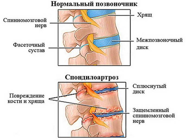 Симптомы боли в сердце при остеохондрозе грудного отдела