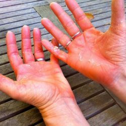 Лечение псориаз на руках - фото, симптомы, виды псориаза на руках