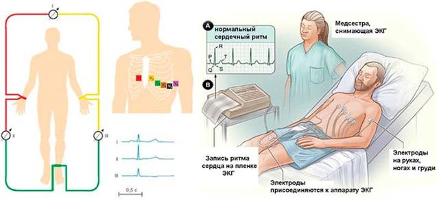 Экг отведения по слопаку - Лечение гипертонии