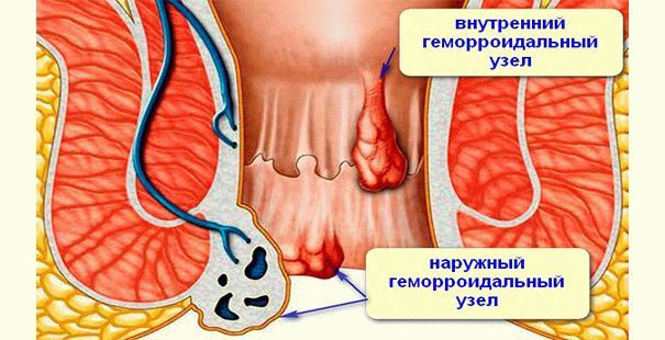 Обострение геморроя - причины, симптомы, лечение, диета и стадии, что делать?