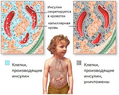 Причины сахарного диабета 1 и 2 типа: почему возникает у взрослых и детей